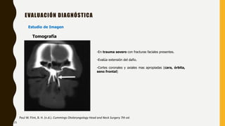 EVALUACIÓN DIAGNÓSTICA
Estudio de Imagen
-En trauma severo con fracturas faciales presentes.
-Evalúa extensión del daño.
-Cortes coronales y axiales mas apropiadas (cara, órbita,
seno frontal)
Paul W. Flint, B. H. (n.d.). Cummings Otolaryngology Head and Neck Surgery 7th ed.
Tomografía
25
 