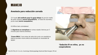 MANEJO
Paul W. Flint, B. H. (n.d.). Cummings Otolaryngology Head and Neck Surgery 7th ed.
Anestesia para reducción cerrada
3) A través del vestíbulo pasar la aguja debajo de porción media
de anillo orbitario (nervio infraorbitario), en base de columela y
punta nasal (nervio nasopalatino).
4) Infiltrar lado contralateral
5) Algodones se reemplazan en ramas nasales internas por 5
minutos para máxima anestesia.
*Crema EMLA 1 hora antes de reducción junto con anestésicos
tópicos proveen mismo efecto de anestesia sin necesidad de
agujas.
*Sedación IV en niños, px no
cooperadores
32
 