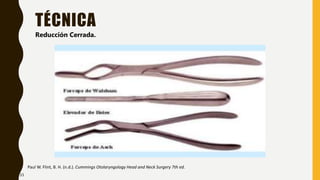TÉCNICA
Paul W. Flint, B. H. (n.d.). Cummings Otolaryngology Head and Neck Surgery 7th ed.
Reducción Cerrada.
33
 