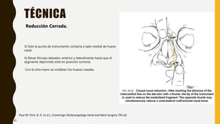 TÉCNICA
Paul W. Flint, B. H. (n.d.). Cummings Otolaryngology Head and Neck Surgery 7th ed.
Reducción Cerrada.
3) Solo la punta de instrumento contacta a lado medial de hueso
nasal.
4) Elevar fórceps elevador anterior y lateralmente hasta que el
segmento deprimido esté en posición correcta.
Con la otra mano se moldean los huesos nasales.
35
 