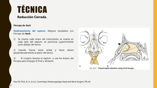 TÉCNICA
Paul W. Flint, B. H. (n.d.). Cummings Otolaryngology Head and Neck Surgery 7th ed.
Reducción Cerrada.
Fórceps de Asch
Realineamiento del septum. Mejores resultados con
Fórceps de Asch.
1) Se inserta cada brazo del instrumento se inserta en
cada lado del septum, se posiciona superiormente
justo debajo del dorso.
2) Usando fuerza hacia arriba y hacia afuera
perpendicularmente al plano del dorso.
3) El cirujano levanta el septum y usa los brazos del
fórceps para empujar el final y alinearlo.
37
 