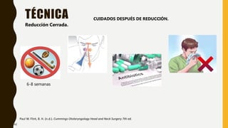 TÉCNICA
Paul W. Flint, B. H. (n.d.). Cummings Otolaryngology Head and Neck Surgery 7th ed.
Reducción Cerrada.
CUIDADOS DESPUÉS DE REDUCCIÓN.
6-8 semanas
42
 