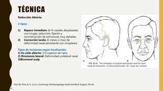 TÉCNICA
Paul W. Flint, B. H. (n.d.). Cummings Otolaryngology Head and Neck Surgery 7th ed.
Reducción Abierta.
2 tipos:
1) Reparo inmediato de fx nasales desplazadas
con cirugía, reducción, fijación y
reconstrucción de estructuras muy dañadas.
2) Corrección tardía (6 meses o mas) de
deformidad nasal persistente con rinoplastia.
Tipos de incisiones según localización:
1) En cielo abierto: 1/3 superior de nariz.
2) Rinotomía lateral: Deformidad unilateral nasal
3)Bicoronal scalp
43
 