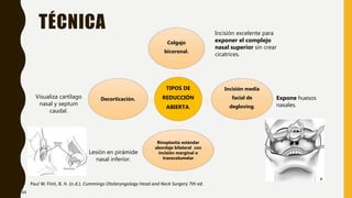 TÉCNICA
Paul W. Flint, B. H. (n.d.). Cummings Otolaryngology Head and Neck Surgery 7th ed.
TIPOS DE
REDUCCIÓN
ABIERTA.
Colgajo
bicoronal.
Incisión media
facial de
degloving.
Rinoplastia estándar
abordaje bilateral con
incisión marginal o
transcolumelar
Decorticación.
Incisión excelente para
exponer el complejo
nasal superior sin crear
cicatrices.
Expone huesos
nasales.
Lesión en pirámide
nasal inferior.
Visualiza cartílago
nasal y septum
caudal.
44
 