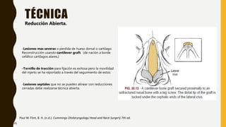 TÉCNICA
Paul W. Flint, B. H. (n.d.). Cummings Otolaryngology Head and Neck Surgery 7th ed.
Reducción Abierta.
-Lesiones mas severas o perdida de hueso dorsal o cartílago:
Reconstrucción usando cantilever graft. (de nación a borde
cefálico cartílagos alares.)
-Tornillo de tracción para fijación es exitosa pero la movilidad
del injerto se ha reportado a través del seguimiento de estos.
-Lesiones septales que no se pueden alinear con reducciones
cerradas debe realizarse técnica abierta.
45
 