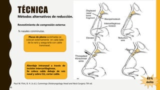 TÉCNICA
Paul W. Flint, B. H. (n.d.). Cummings Otolaryngology Head and Neck Surgery 7th ed.
Métodos alternativos de reducción.
Revestimiento de compresión externa:
fx nasales conminutas.
Placas de plomo acolchadas se
colocan externamente en cada lado
de la nariz y asegurarla con cable
transnasal..
Abordaje intranasal a través de
incisión intercartilaginosa,
Se coloca cable debajo de raíz
nasal y sobre CLI, cortar cable.
85%
éxito
46
 