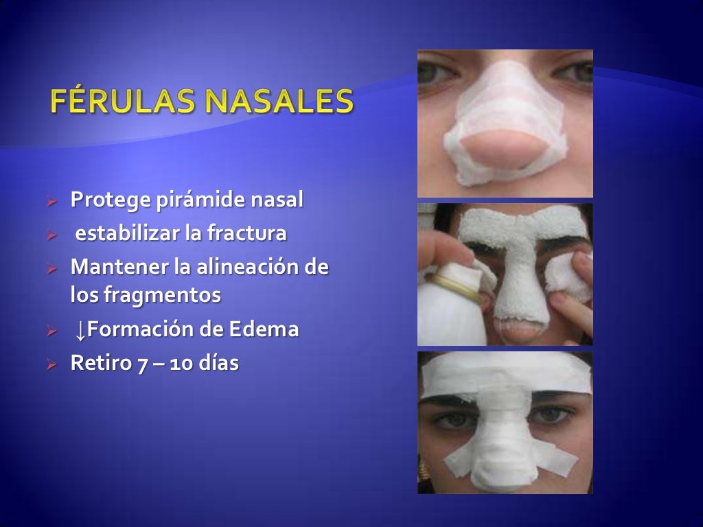 Férula En La Nariz Fracturas nasales Dr Gabriel Hinojosa Pardo