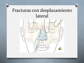 Fracturas nasales y faciales