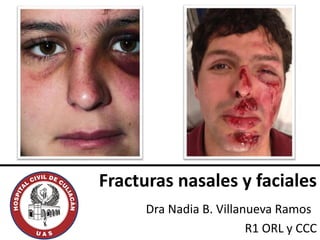 Fracturas nasales y faciales
Dra Nadia B. Villanueva Ramos
R1 ORL y CCC
 