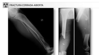 FRACTURA CERRADA-ABIERTA
 