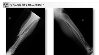 FX DIAFISARIAS: TIBIA-PERONE
 