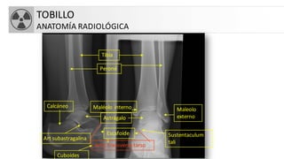 TOBILLO
ANATOMÍA RADIOLÓGICA
Tibia
Peroné
Astrágalo
Maléolo interno Maleolo
externo
Calcáneo
Escafoide
s
Sustentaculum
tali
Artic transversa tarso
Cuboides
Art subastragalina
 