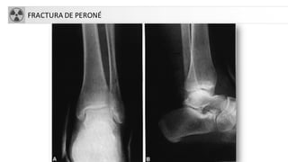 FRACTURA DE PERONÉ
 