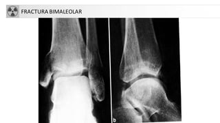 FRACTURA BIMALEOLAR
 