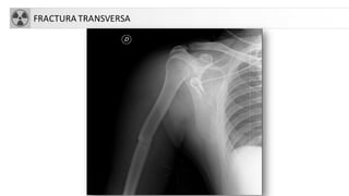 FRACTURA TRANSVERSA
 