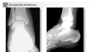 FX-LUXACIÓN ASTRÁGALO
 