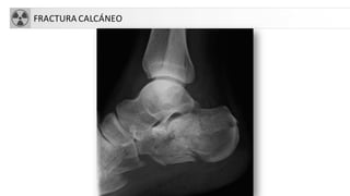 FRACTURA CALCÁNEO
 