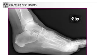 FRACTURA DE CUBOIDES
 