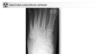 FRACTURA LUXACIÓN DE LISFRANC
 