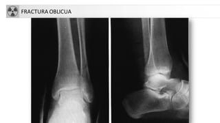 FRACTURA OBLICUA
 