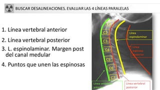 BUSCAR DESALINEACIONES.EVALUAR LAS 4 LÍNEAS PARALELAS
1. Línea vertebral anterior
2. Línea vertebral posterior
3. L. espinolaminar. Margen post
del canal medular
4. Puntos que unen las espinosas
C1
C2
C3
C4
C7
C6
C5
Línea vertebral
anterior
Línea vertebral
posterior
Línea
espinolaminar
Línea
espinosa
posterior
 