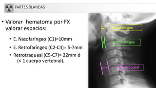 PARTES BLANDAS
• Valorar hematoma por FX
valorar espacios:
• E. Nasofaríngeo (C1)=10mm
• E. Retrofaríngeo (C2-C4)= 5-7mm
• Retrotraqueal (C5-C7)= 22mm ó
(< 1 cuerpo vertebral).
Nasofaríngeo
Retrofaríngeo
Retrotraqueal
 