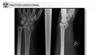 FRACTURA LONGITUDINAL
 