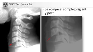 BILATERAL (inestable)
• Se rompe el complejo lig ant
y post.
 