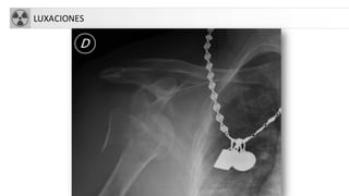 LUXACIONES
 