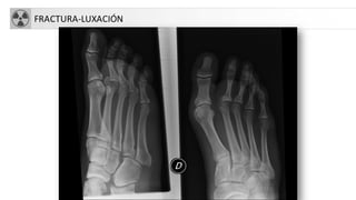 FRACTURA-LUXACIÓN
 