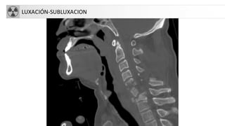 LUXACIÓN-SUBLUXACION
 