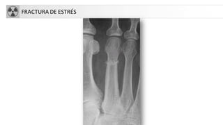 FRACTURA DE ESTRÉS
 