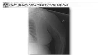 FRACTURA PATOLÓGICA EN PACIENTE CON MIELOMA
 