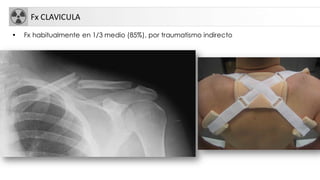 Fx CLAVICULA
• Fx habitualmente en 1/3 medio (85%), por traumatismo indirecto
 