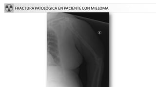 FRACTURA PATOLÓGICA EN PACIENTE CON MIELOMA
 