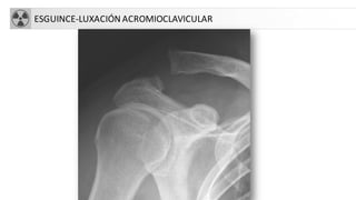 ESGUINCE-LUXACIÓN ACROMIOCLAVICULAR
 