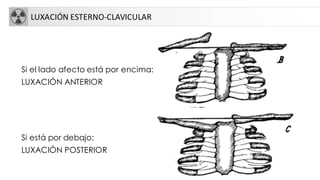 LUXACIÓN ESTERNO-CLAVICULAR
Si el lado afecto está por encima:
LUXACIÓN ANTERIOR
Si está por debajo:
LUXACIÓN POSTERIOR
 