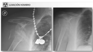 LUXACIÓN HOMBRO
 
