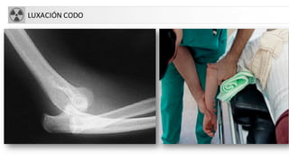 LUXACIÓN CODO
 