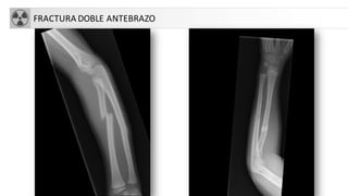 FRACTURA DOBLE ANTEBRAZO
 