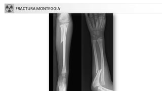 FRACTURA MONTEGGIA
 