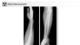 FRACTURA GALEAZZI
 