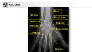 ANATOMÍA
Trapezoides
Radio
Cubito
Escafoides
Semilunar
Piramidal
Trapecio
Grande
Ganchoso
 