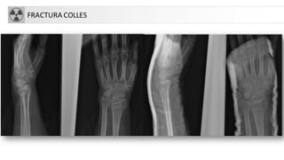 FRACTURA COLLES
 