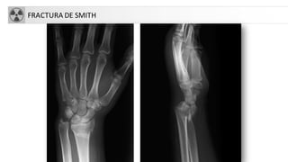 FRACTURA DE SMITH
 