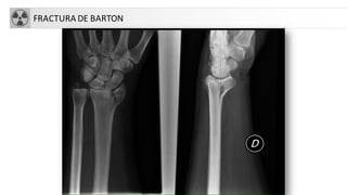 FRACTURA DE BARTON
 