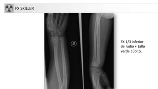 FX SKILLER
FX 1/3 inferior
de radio + tallo
verde cúbito.
 