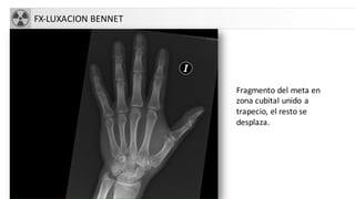 FX-LUXACION BENNET
Fragmento del meta en
zona cubital unido a
trapecio, el resto se
desplaza.
 