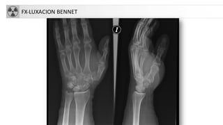 FX-LUXACION BENNET
 