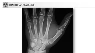 FRACTURA 1ª FALANGE
 